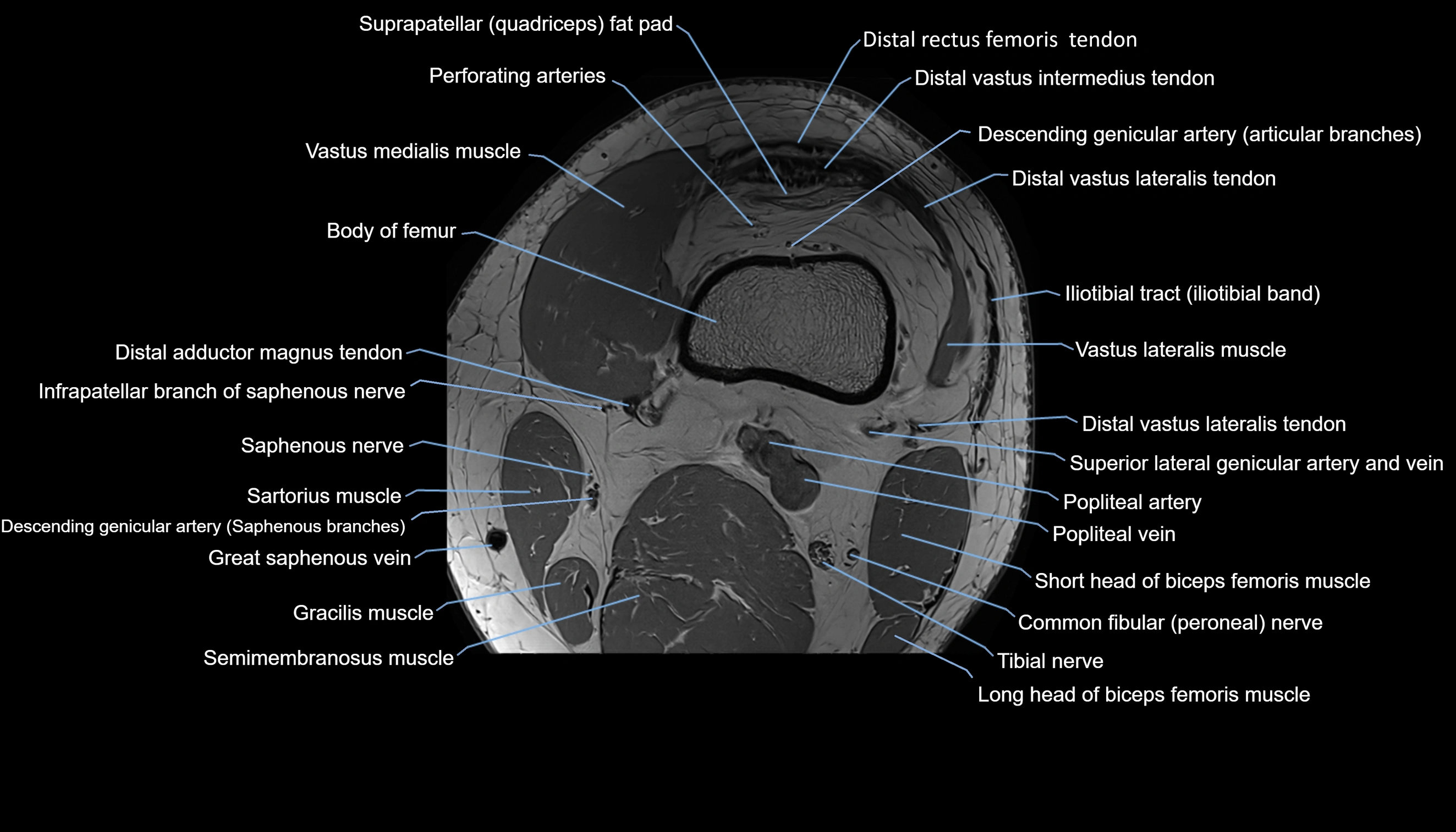 MRI knee  axial cross sectional anatomy 3T radiology  image-img-00001-00004.webp